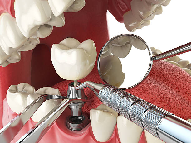 Best Emergency Tooth Extraction in Round Rock, TX